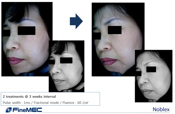 máy trị nám hiệu quả