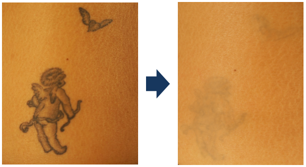 máy laser xóa xăm hiệu quả