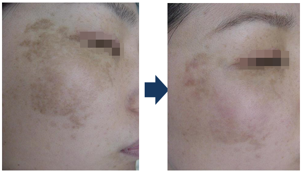 Máy laser trị nám hiệu quả
