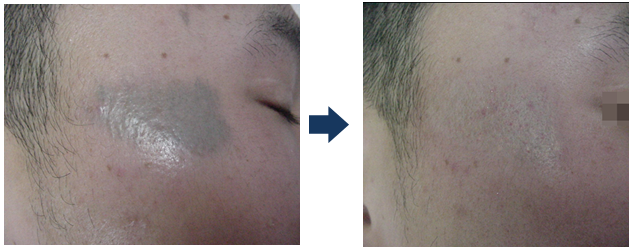 Máy laser trị bớt, tan nhang, nám hiệu quả