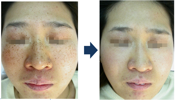 Máy laser điều trị tan nhang