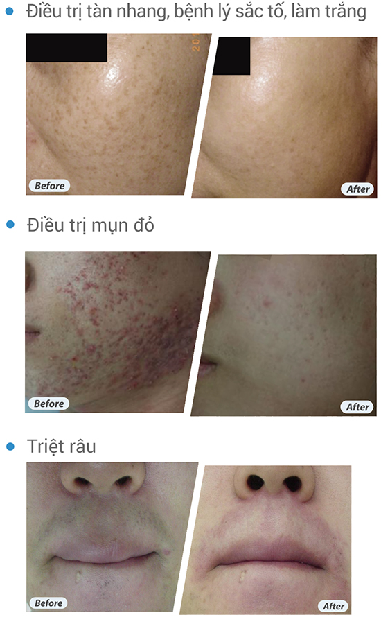 Nobleen- Hinh ảnh trị liệu